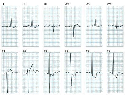 10 vagy kevesebb, iránya +80 o és -30 o között és mindig poszterior irányú a 12 elvezetésben a QRS amplitudó összege >185 mm A Q hullám I és V