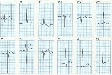 regurgitáció, aorta billentyű myxomatosus degenerációja, endocarditis, trauma, aorto-annularis dysplasia, mitrális regurgitáció, ventrikuláris