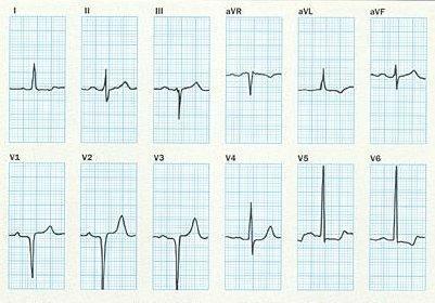 P II. elvezetésben 0.12 sec, 0.15 mm magas, +65 o, V 1 -ben magasp hullám PR távolság 0.20 sec QRS 0.08 sec, intrinsicoiddeflection 0.