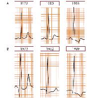 QRS-T szög 120 o Bal pitvaribal kamrai hypertrófia (aorta regurgitáció) 26 Aorta sztenózis Aorta regurgitáció Bal kamra hypertrófia dg. kritériumai Kritériumok R hullám I. elvezetésben + S hullám III.