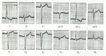 V 6 > 35 mm, R I + S III > 25 mm Romhilt-Estes kritériumok (Am Heart J, 16:75:752-58) Kamrai hullám amplitudója(3 pont) a legnagyobbr vagy S hullám végtag elvezetésben 20 mm vagy nagyobb az S hullám