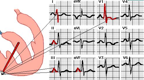 10 sec vagy kevesebb iránya +90 o, anterior irányú az R hullám jól látható V 1 -ben (> 7 mm) V 1 van legközelebb a jobb kamrához T hullám iránya