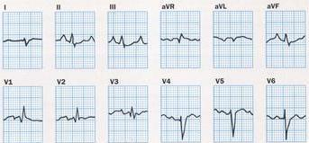 elvezetésben is QRS amplitudója kicsi hyperinfláció miatt a tüdő szövetrosszul