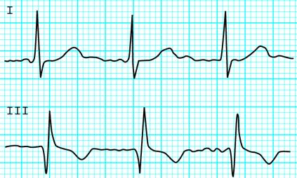 Pulmonális embólia Akut tüdőembólia S 1 Q 3 T 3 jelenség és Jobbszárblokk S 1 Q 3 T 3 Masszív