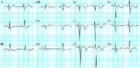 tachycardia, pitvari fibrillációés flattern Jobb szárblokk T hullám inverzió a jobb prekordiális