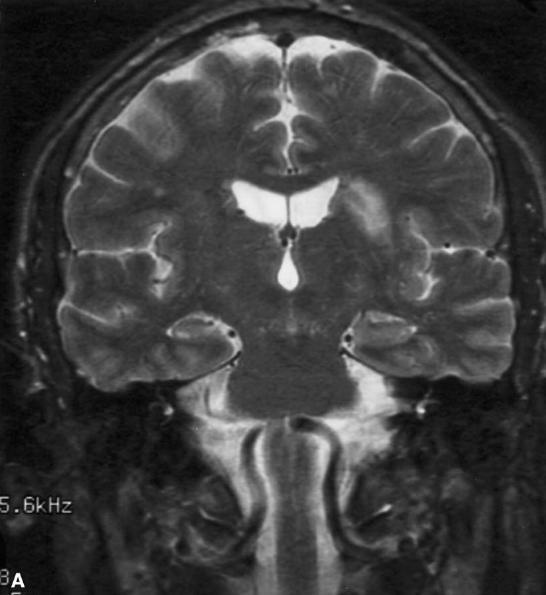 A neurofiziológiai modellt alátámasztó esetismertetés 63 éves fül-orr-gégész, 40 éve folyamatos, magas frenvenciájú tinnitus.