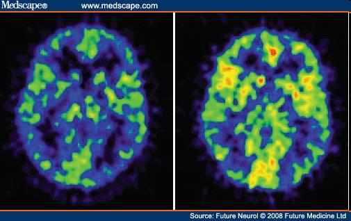*** Positron emission tomography shows decreased cerebral blood flow in a 34-year-old male patient (left) with strokes compared with a