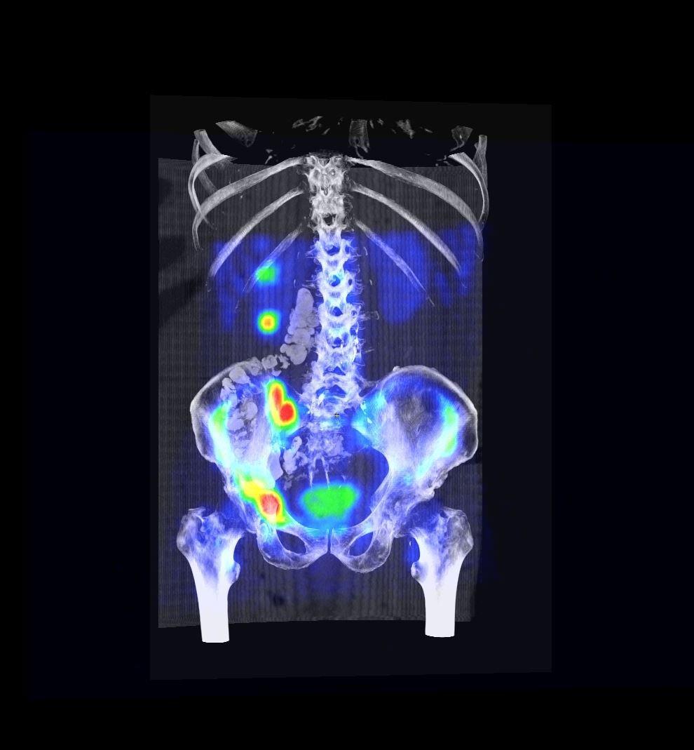 CSONT SPECT-CT