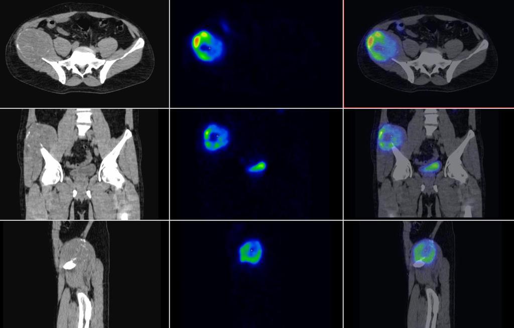 Paraganglioma a jobb