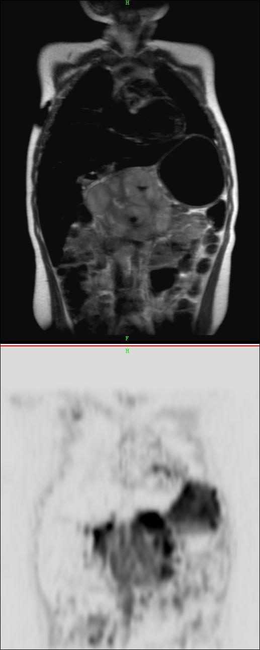 FDG-PET/CT (2010.11.08.