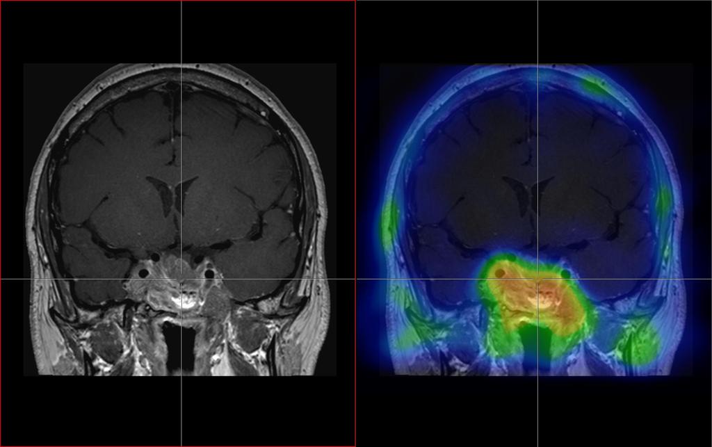 SPECT-CT és MR fúzió