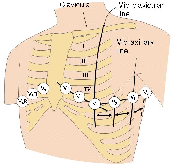 Precordial leads MELLKASI EKG ELVEZETÉSEK A JEL POLARITÁSA A TERJEDŐ INGERÜLETI HULLÁM FÜGGVÉNYÉBEN Towards theelectrode= positivedeflection ELECTRODES AROUND THE HEART Away from the electrode =