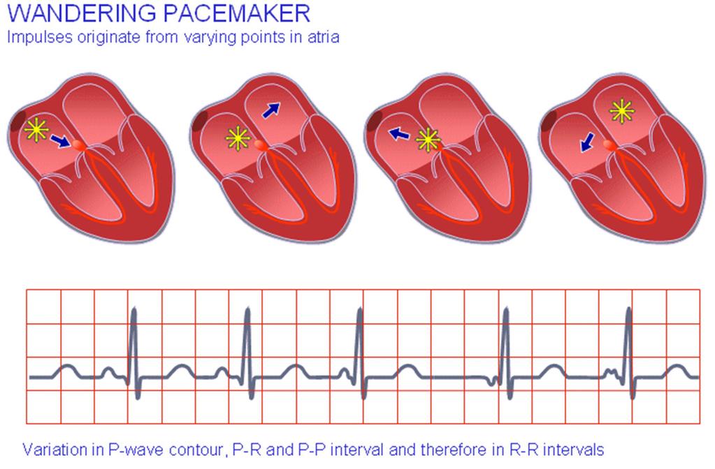 called sinus tachycardia.