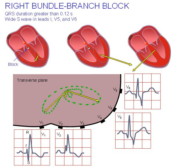 A premature ventricular contraction is one that occurs abnormally early.