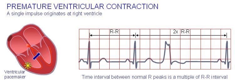 The complex produced by this supraventricular arrhythmia lasts less than 0.1 s.