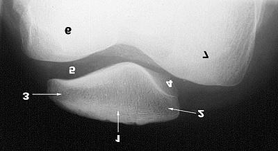 A PATELLA AXIÁLIS RTG-FELVÉTELEN 1. Patella 2. Pars medialis 3. Pars lateralis 4.