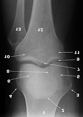 A TÉRDÍZÜLET AP RTG-FELVÉTELEN 1. Femur 2. Patella 3. Epicondylus med. femoris 4. Epicondylus lat. femoris 5. Condylus medialis femoris 6.