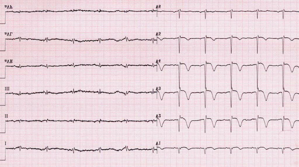 Az EKG-t