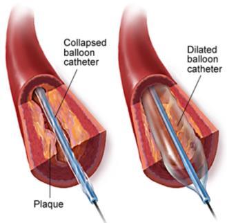 Egyszerű ballonos angioplasztika (POBA) Kontrollált érfal trauma, számos szövődménnyel: