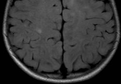 Leptomeningeal infectio > terjedés az erek mentén > vasculitis > trombózis Vénás trombózis