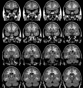 Metachromasias