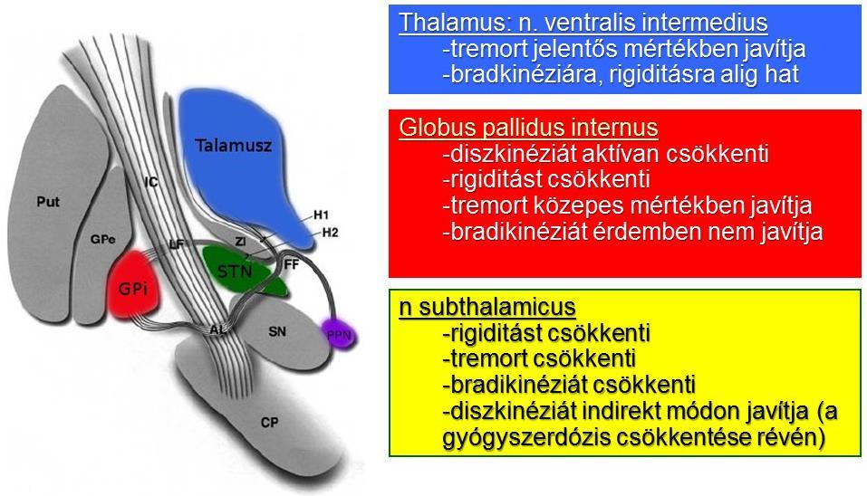 Az STN DBS kezelés további előnye, hogy általában csökkenthető a korábban szedett gyógyszerek mennyisége is.