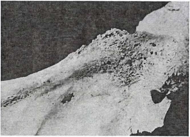 ábra: Osteoplasticus léziók a cavitas glenoidale környékén (jobb oldal).