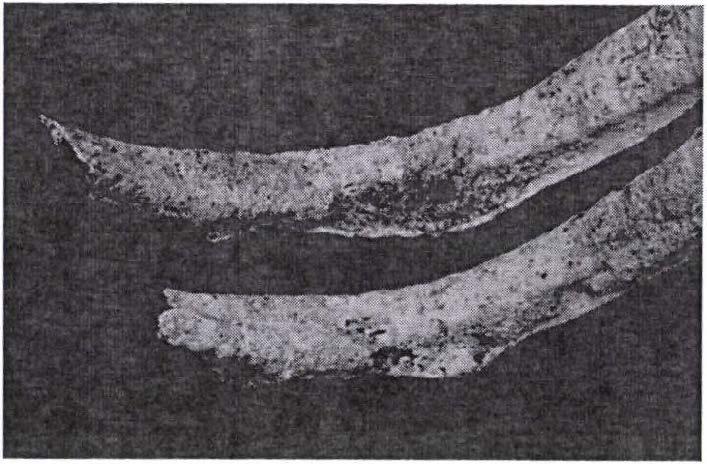 Figure 6: Osteolytic and mixed lesions of a vertebral arch and transverse