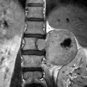9. ábra: Neurofibroma, intraduralis elhelyezkedés [órai jegyzet] 3.