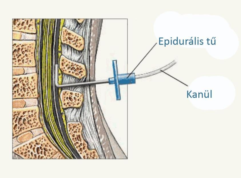 EPIDURÁLIS ÉRZÉSTELENÍTÉS, KANÜL BEHELYEZÉS MI AZ EPIDURÁLIS FÁJDALOMCSILLAPÍTÁS, TERÁPIA?