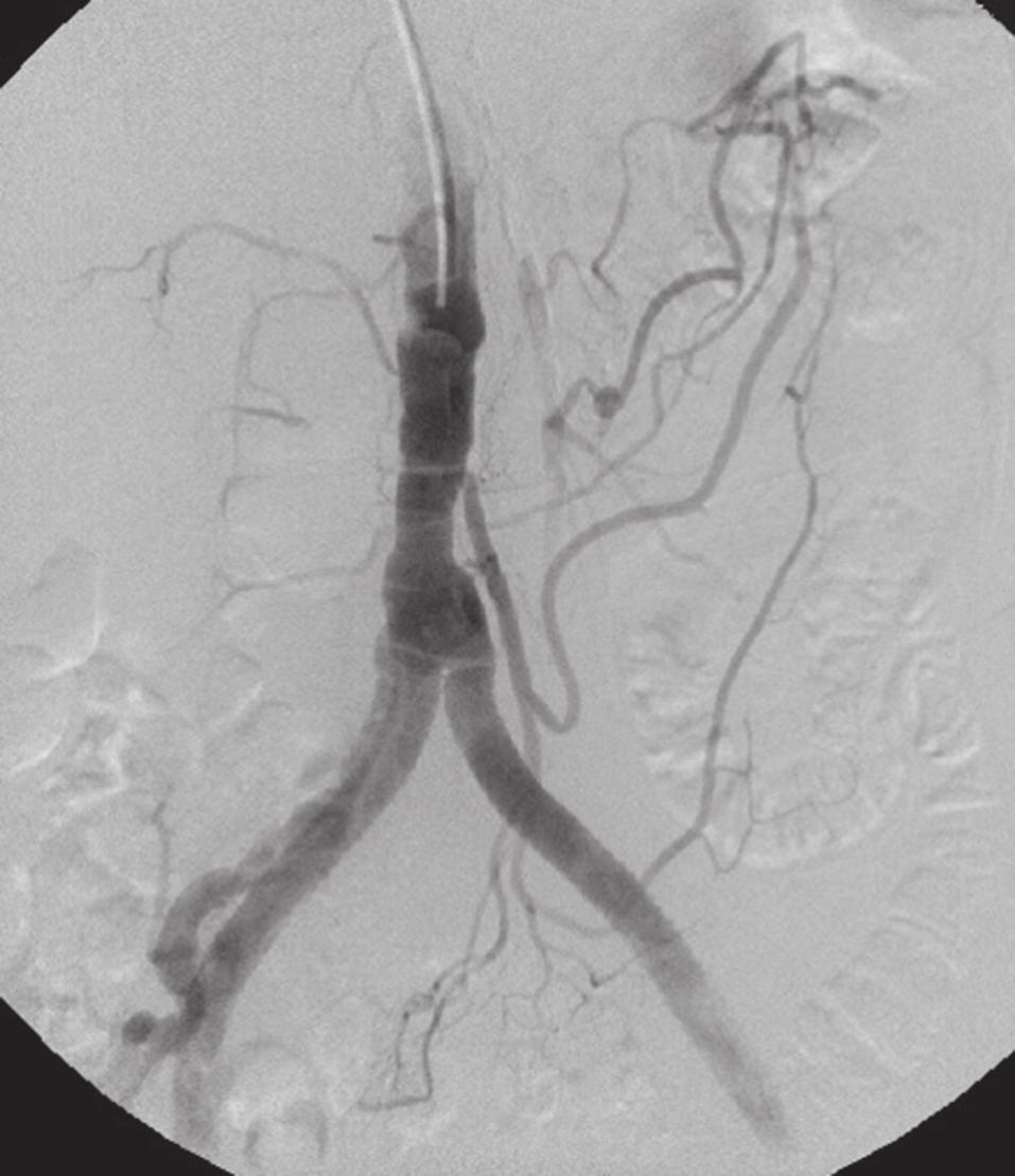 MIP CT-rekonstrukció az arteria mesenterica superior stentelése után. Jó helyzetű nitinolstent az arteria mesenterica superior proximalis szakaszában.