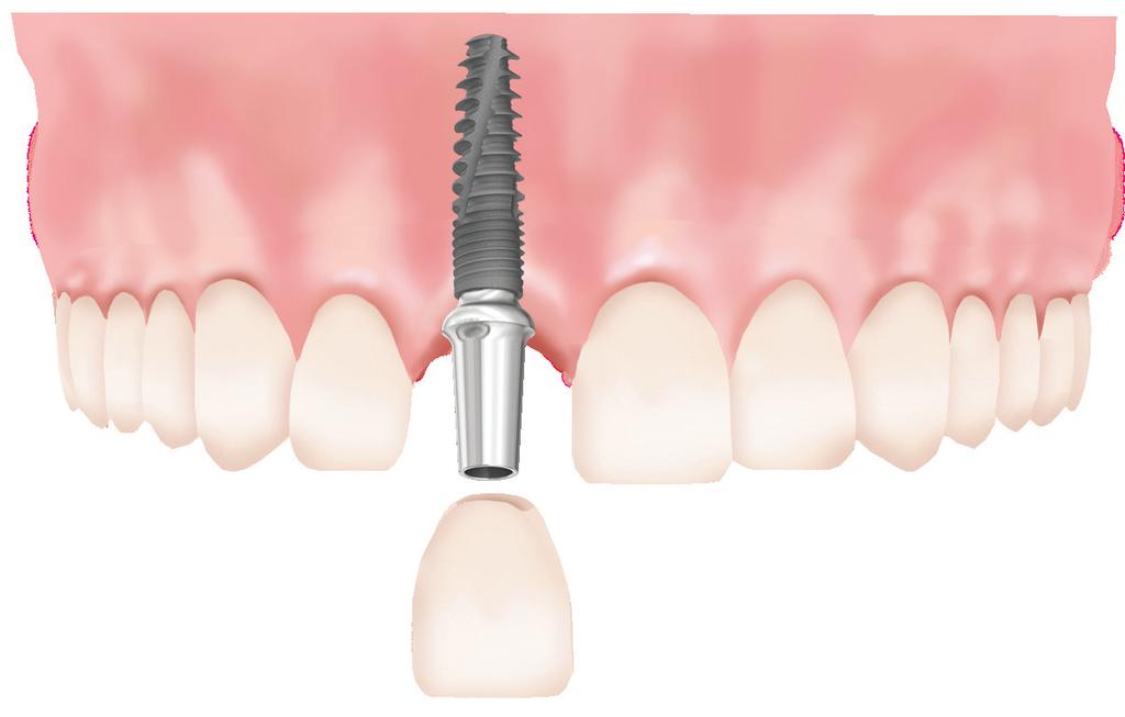 18 CORTILOG Implant System A CORTILOG alkalmazási területei Egy foghiány esetén Ilyenkor egy fog pótlásához nem