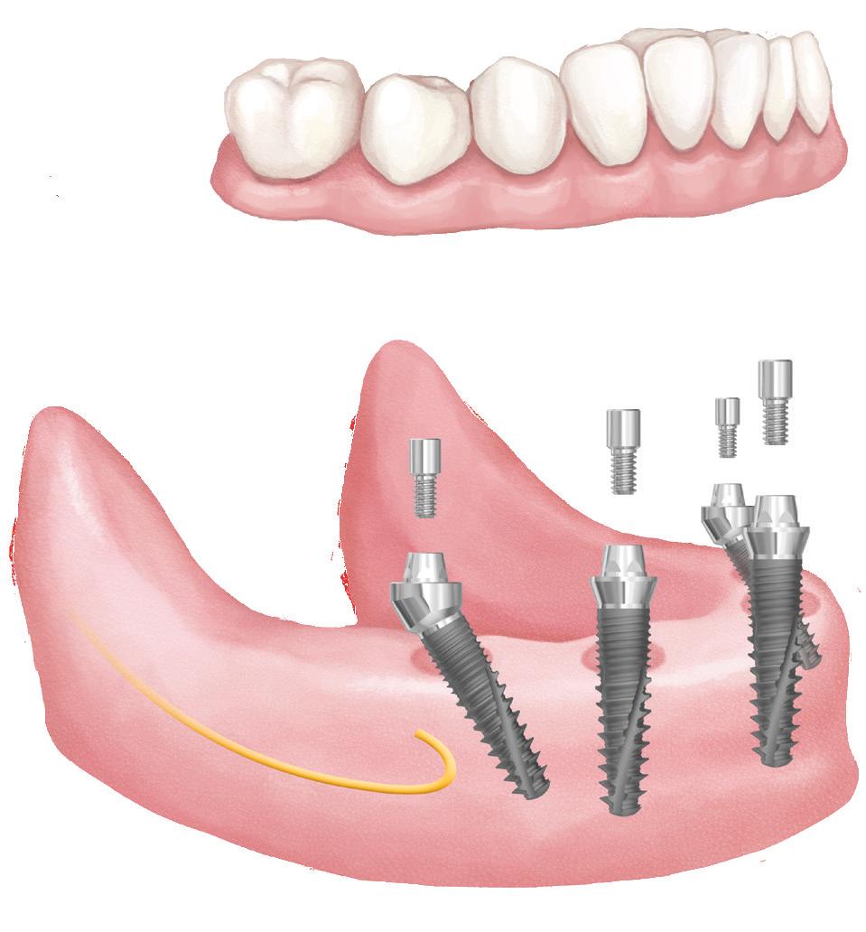 A dönthető hátsó implantátumokat jobban lehet rögzíteni az elülső csontba. Ez elősegíti a protézis alátámasztását.