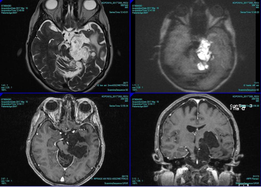 Az epidermoid cysta