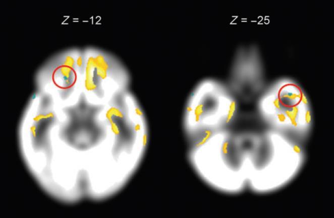 superior, a bal gyrus temporalis inferior és mindkét oldali temporalis pólus vonatkozásában (12. táblázat). 12.