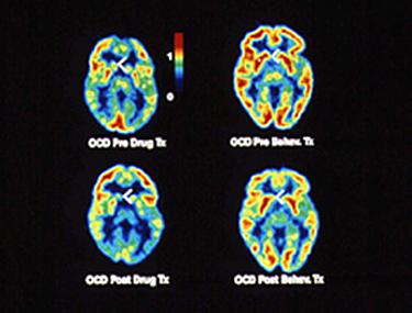 OCD - változás a terápia hatására