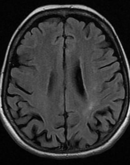 57 éves nő Távoli anamnézis: HBV, folyamatos antiviralis terápia