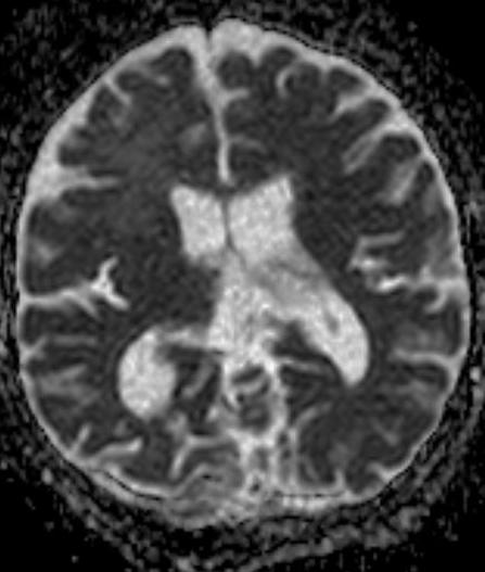 lenne) kizárható Encephalitis a kép alapján szóba jön, a lassú lefolyás miatt