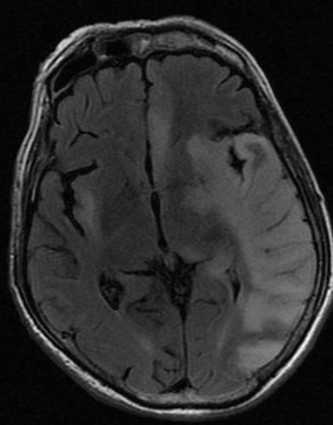 Herpes encephalitis Latens HSV-1 vírus reaktivációja Terjedés: