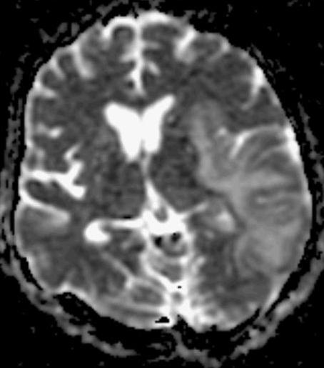 infiltratio, cytotoxikus hatás Subcorticalisan vasogen,