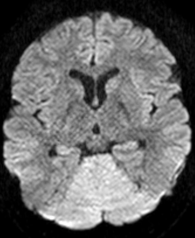 Hasonló leptomeningealis kontraszthalmozás és