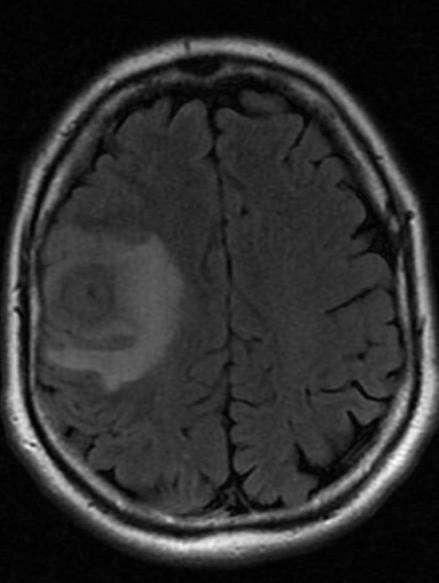 Abscessus - MR eltérések Alacsony T2 jeladású