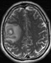 Differenciál diagnosztika: nekrotikus tumorok