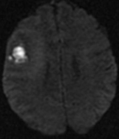 Abscessus típusos diffúziógátlás Erős diffúziógátlás