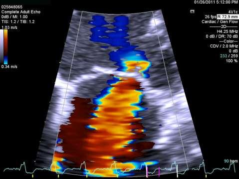 A mitralis regurgitatio PISA radius: 0.84 cm Va(Aliasing velocity): 34 cm/s V reg (MI Vmax): 4.