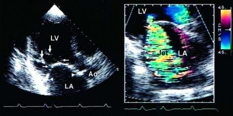 Más echocardiographiás