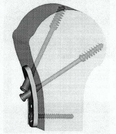 6. ábra A szöglettartó, dinamikus, kompressziós osteosynthesis Cadaver kísérletek: Az implantátumon stabilitási vizsgálatokat végeztünk.
