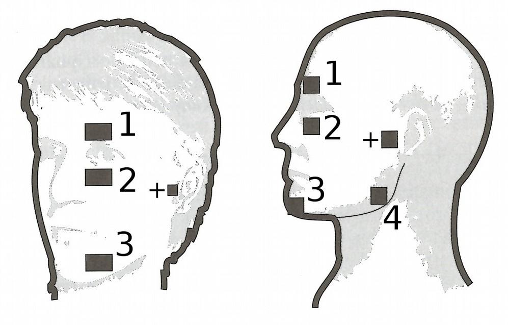 Trigeminus neuralgia kezelés A + -al jelzett pontra helyezendő a pozitív, piros kábeles elektróda.