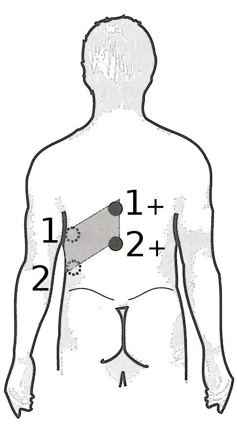 Posztherpeszes neuralgia kezelése A pozitív ( + ) elektróda