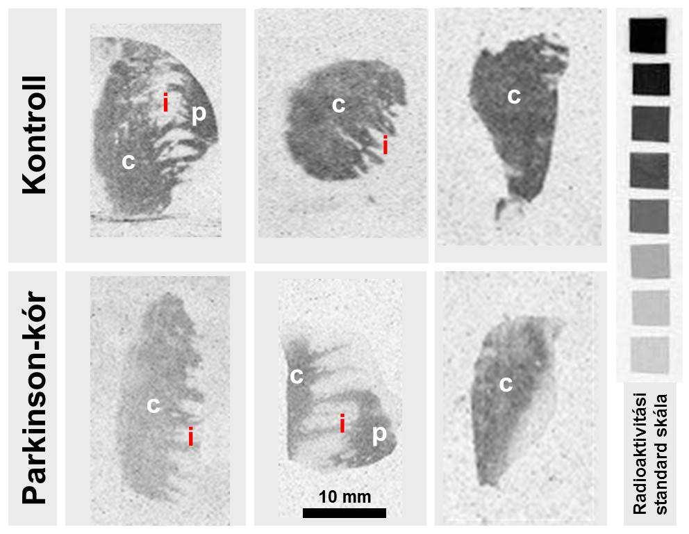 3. táblázat. Dopamin D 2 /D 3 receptor kötődés fmol/gramm szövetben kifejezve emberi nucleus caudatus, gyrus frontalis medialis és gyrus cinguli mintákon.